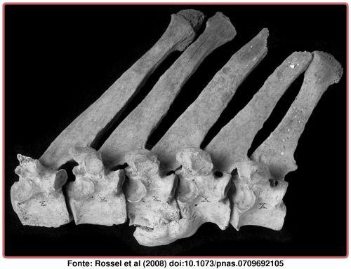 Arthropathies vertébrales.