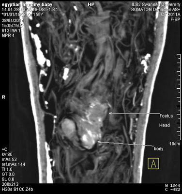 CT scan showing foetus and placental sac.