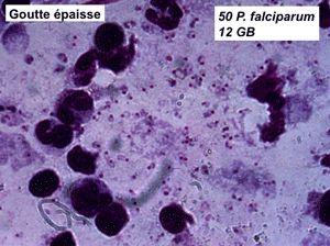 03 falciparum goutte